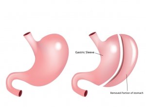 Can I Get Pregnant After Gastric Sleeve Surgery?